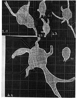 20. Venous engorgement. 21. After pressure over internal 22. Same case, normal. 23. Scotoma after ligation of common carotid. 24. Edematous swelling of nerve and retina. 25, Normal blind spot of other eye.