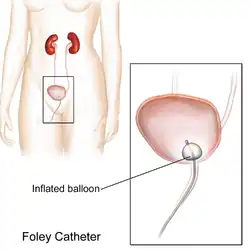 Foley Catheter Illustration