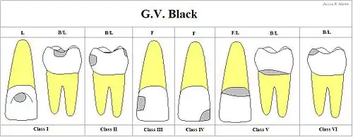 Chart showing digitally drawn images of caries locations and their associated classifications.