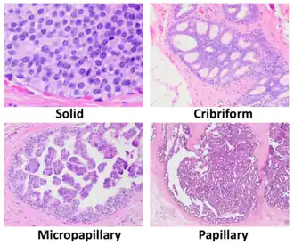 Histopathologic architectural patterns of DCIS.[24]
