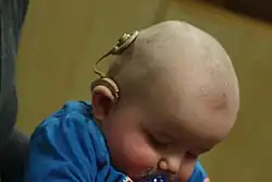 A baby with a cochlear implant