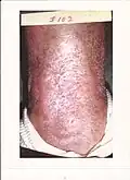 Intractable leg ulcer above the ankle healed after 102 DeMarco formula treatments