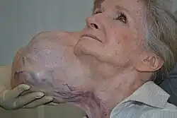 A 71-year-old woman with a massive tumour protuding from the side of her head and neck