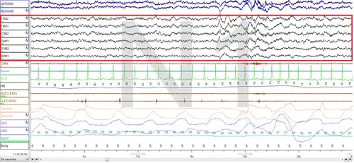 Stage N1 Sleep. EEG highlighted by red box.