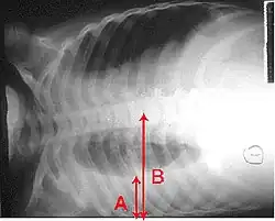 An X-ray showing a chest lying horizontally. The lower black area, which is the right lung, is smaller with a whiter area below it of a pulmonary effusion. Red arrows indicate size.