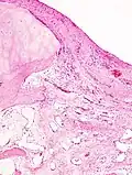 Histopathology of osteoarthrosis of a knee joint in an elderly female