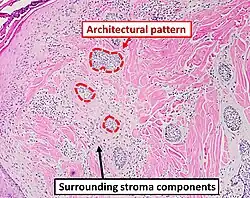Architectural pattern of any suspicious cells, in this case nests of cells, as well as components of the intervening stroma.