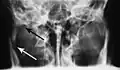 Towne's view of a bilateral condyle fracture. White arrow is a fracture on the neck of the condyle. Black arrow shows the condyle pulled to the medial. The same injury can be seen on the opposite side