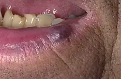 A small blue- to purple-colored lesion on the lower lip of an adult
