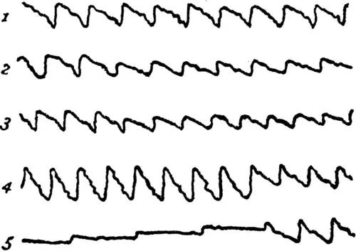 1. Sphygmograph record of healthy pulse under normal conditions. 2 and 3 Sphygmograph records of Dmitri Vasili and Ivan Munikov when Eva Silber told of her father's betrayal: the lower and rapid pulsation thus recorded indicate grief and horror. 4. Record of Meyan on this occasion; the strong and bounding pulse indicates joy. 5. Meyan's sphygmograph record when Trant shows the yellow note that betrayed Herman Silber; the feeble, jerky pulse indicates sudden and overwhelming fear.