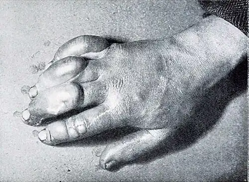 Photo of a hand with huge blisters on the fingers