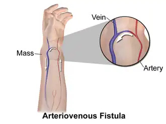 Arteriovenous fistula.