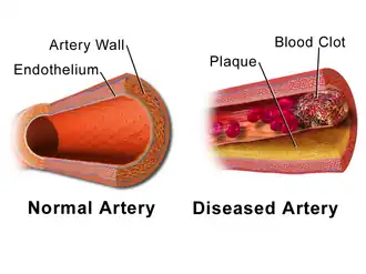 Normal artery vs. one with atherosclerotic plaque and blood clot.