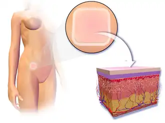 Contraceptive patch.