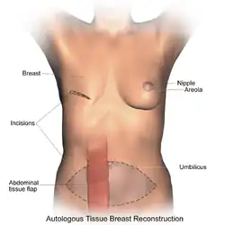 Breast reconstruction using autologous tissue (TRAM).