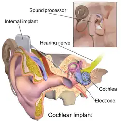 Cochlear implant.