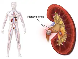 Kidney stones.