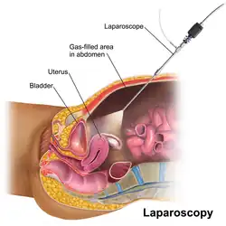 Laparoscopy.