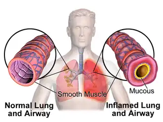 Normal airway versus airway with bronchoconstriction
