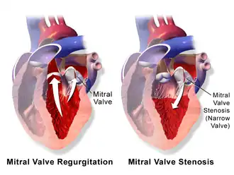 Mitral valve regurgitation and stenosis.