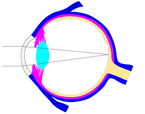 The previous image was downloaded, edited and resubmitted a dilated pupil. Diagrams like this could be used to better understand why night driving is difficult for people who are nearsighted. This sketch ignores the bending of light by the eye lens because we have not ascertained a typical focal length for that lens. The student who figures this out gets to post the corrected version.