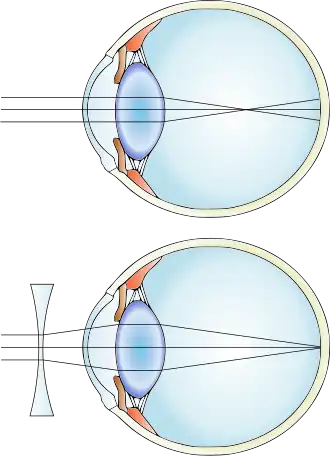 File:Myopia and lens correction.svg