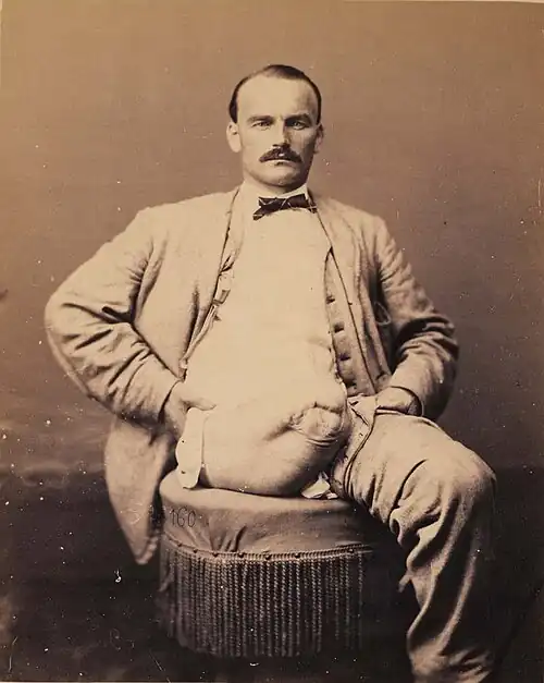 Wbell-leg-amputation